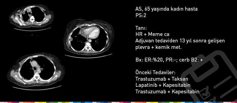 HER-2 Pozitif Meme Kanseri TDM-1