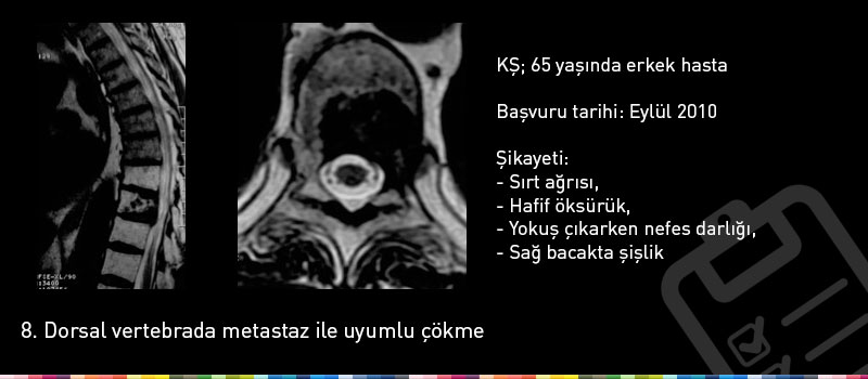 ALK Akciğer Kanseri Crizotinib